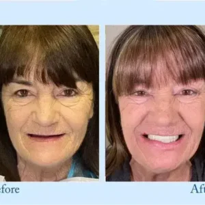 Dentures - Image 14