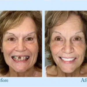 Dentures - Image 14