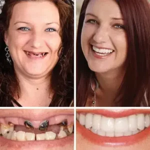 Soft Silicone Carbon Ceramic Teeth, Strong and White – Natural Look, Comfortable Fit - Image 13