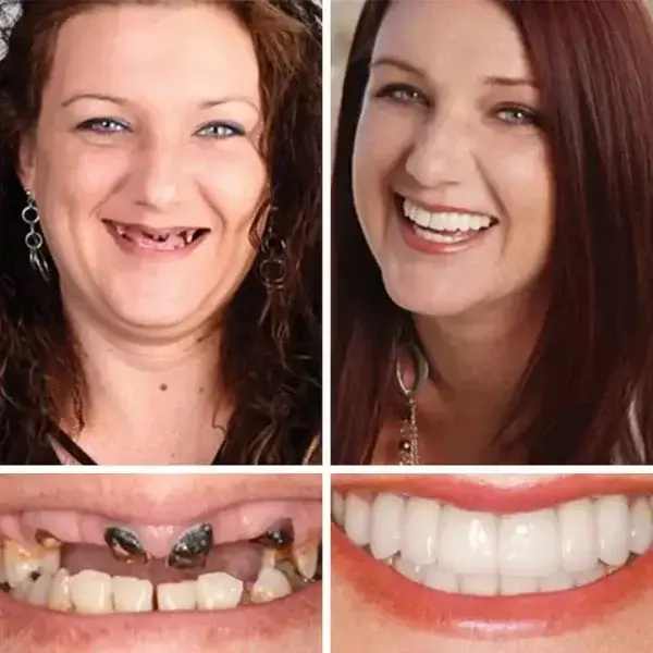 Premium Full Denture Set - Image 11