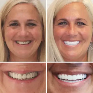 Full Denture Set🦷🦷💃Advanced Self-Adjusting Dental Materials (⏰Limited time discount last 30 minutes⏰) - Image 5