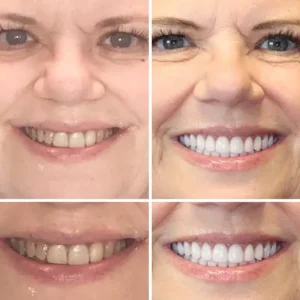 Full Denture Set🦷🦷💃Advanced Self-Adjusting Dental Materials (⏰Limited time discount last 30 minutes⏰) - Image 6