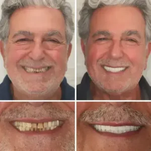 【Official Brand Store】Custom-Fit Functional Dentures — ComfortMax Edition - Image 10