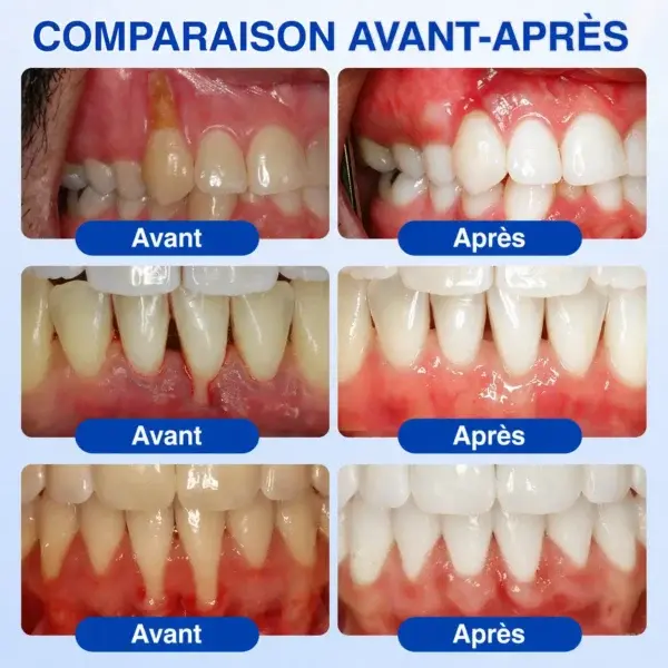 Gel Régénération Parodontale - Image 12
